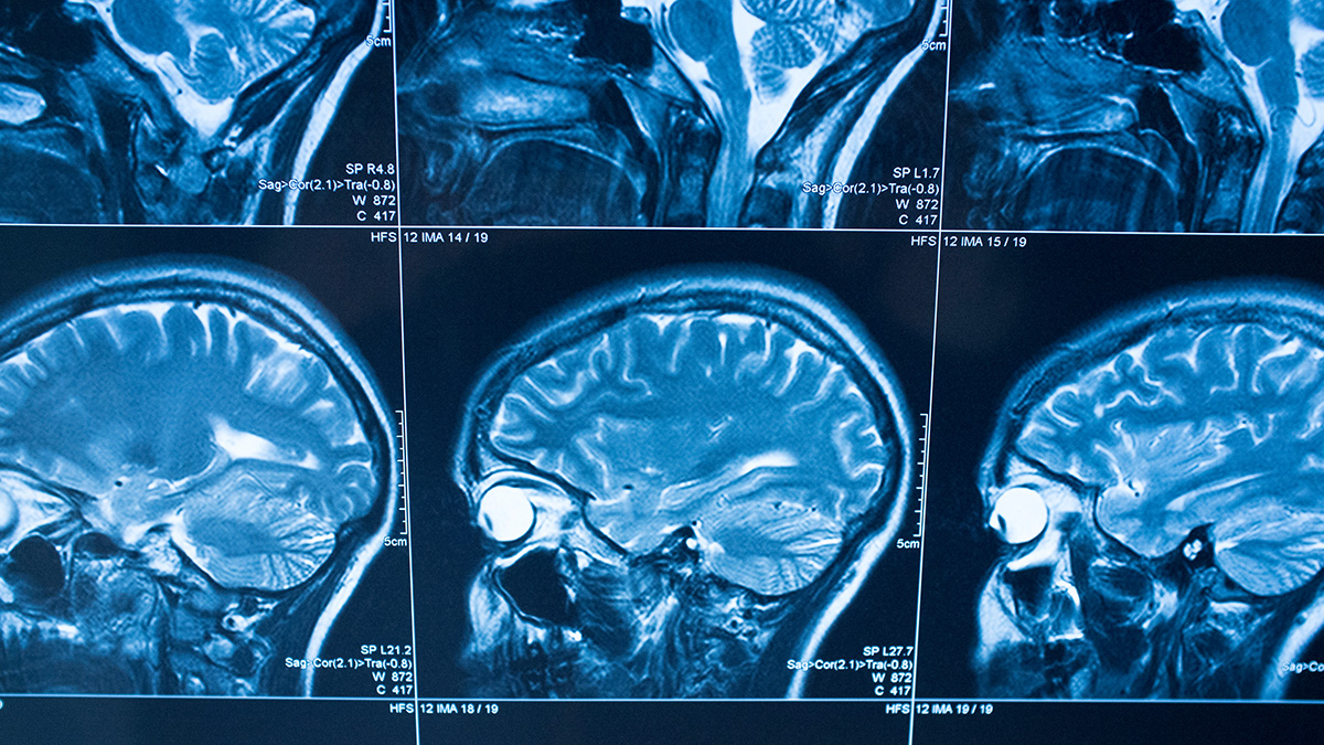 About Stroke MRI images of a person's head and brain